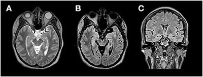 Case report: Anti-GAD65 antibody-associated autoimmune encephalitis following HPV vaccination